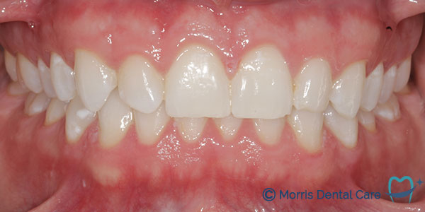 Professional whitening treatment at Morris Dental Care - for a brighter, more vibrant smile.
